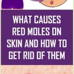 WHAT DO THE RED MOLES ON THE BODY MEAN?
